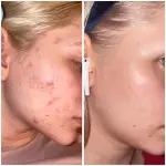 Acide Hyaluronique 2% + B5 - Sérum Hydratant